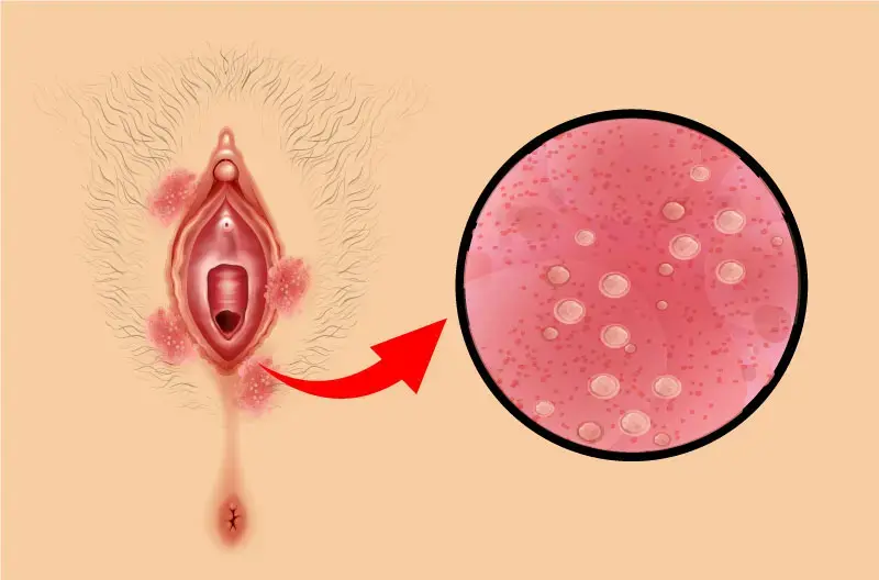 Les Mycoses Vaginales : Prévention et Prise en Charge