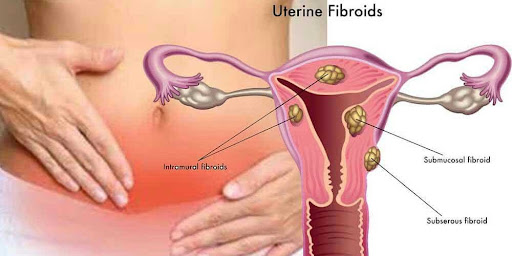 Le Fibrome Utérin : Quand Faut-il S’inquiéter et Comment le Traiter ?