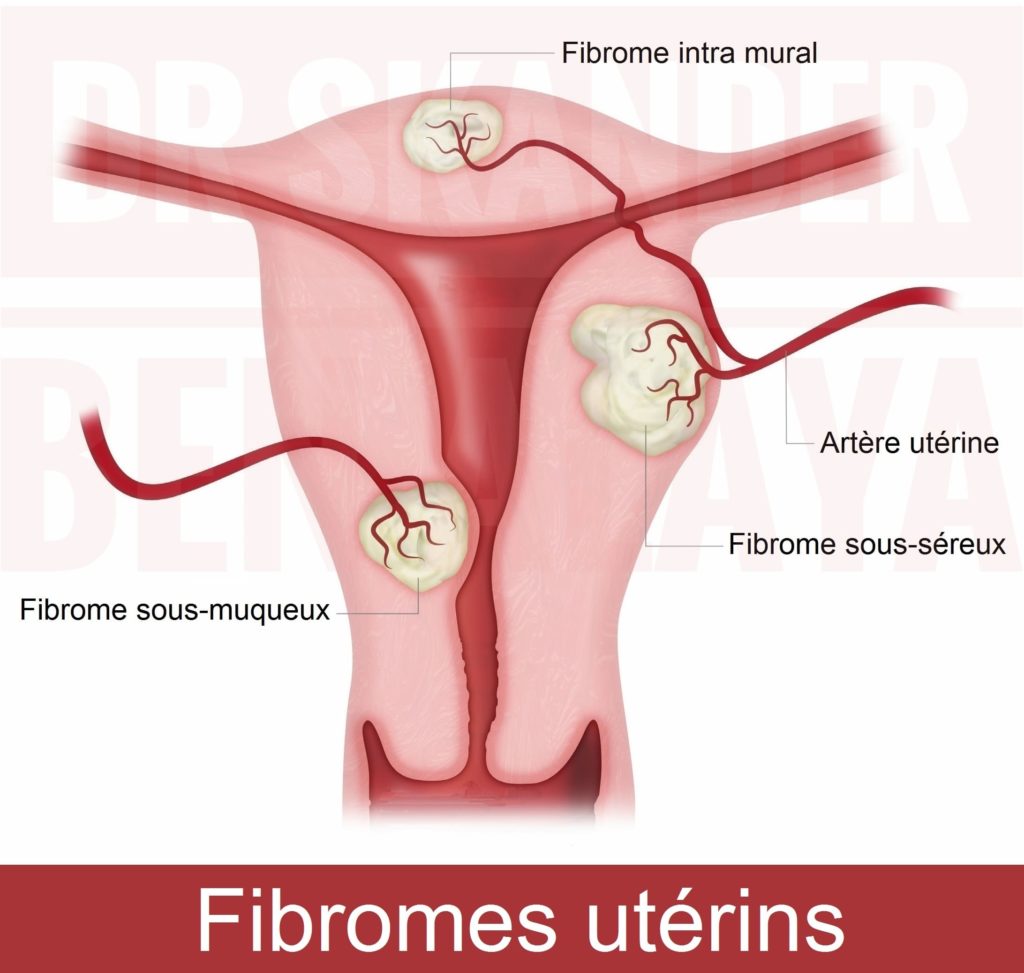 Le Fibrome Utérin : Quand Faut-il S’inquiéter et Comment le Traiter ?